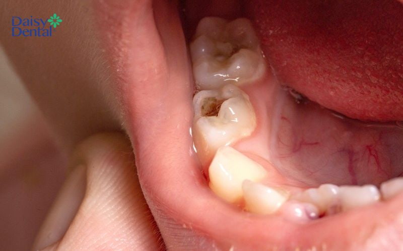 Sâu răng không được điều trị kịp thời có thể lây lan sang bên cạnh và làm mất răng