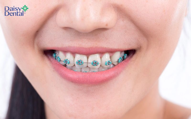 Nắn chỉnh răng là phương pháp nha khoa chuyên sâu giúp cải thiện tình trạng lệch lạc của răng