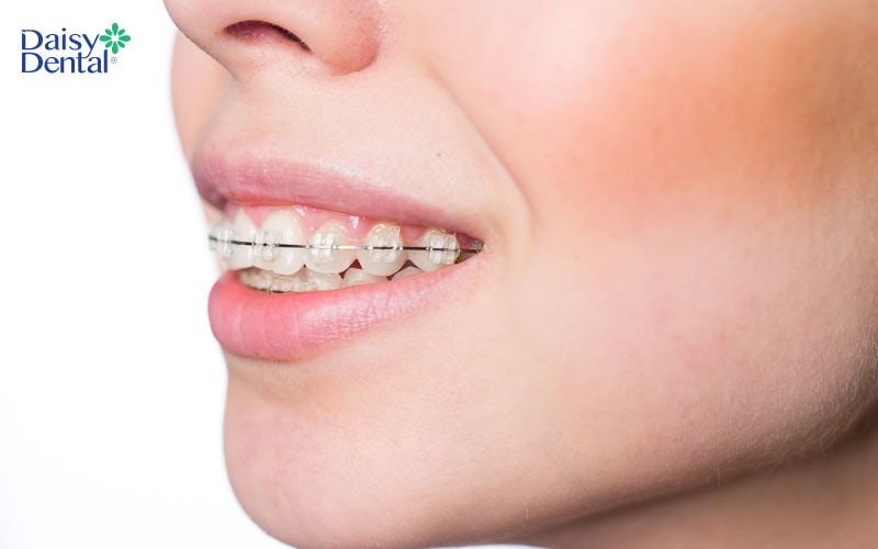 Răng vẩu là một trong những trường hợp cần nắn chỉnh răng