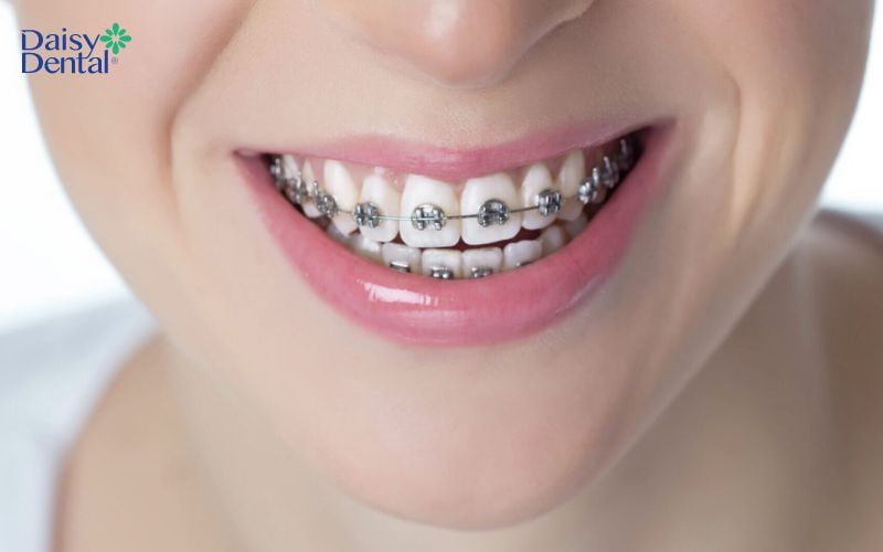 Niềng răng mắc cài sử dụng dây cung và mắc cài để đưa răng về vị trí mong muốn
