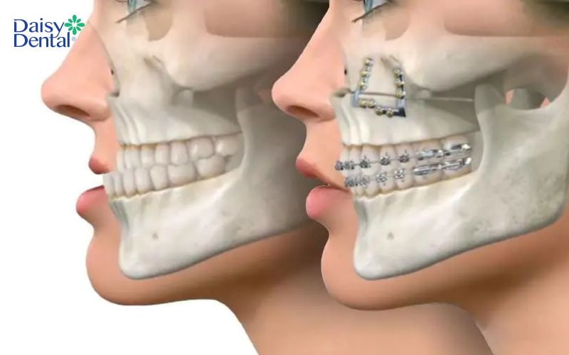 Bệnh nhân có thể được chỉ định cắt bỏ hoặc ghép thêm xương vào hàm trước khi chỉnh răng