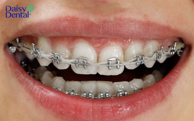 Chỉnh nha bằng mắc cài kim loại