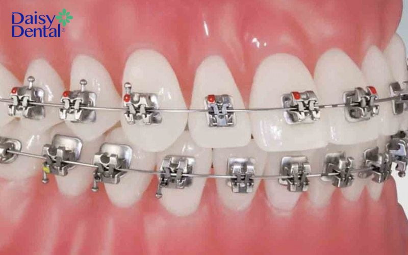 Hệ thống mắc cài kim loại tự đóng