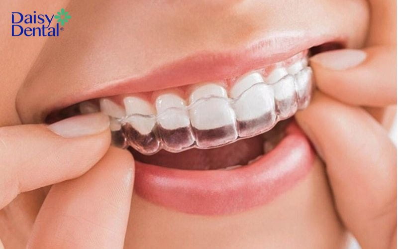  Chỉnh nha bằng khay niềng trong suốt