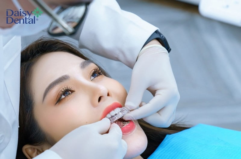 Mức giá của chỉnh nha bằng mắc cài và khay niềng thường có chênh lệch
