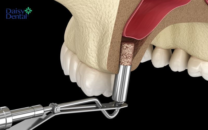 Nâng xoang là kỹ thuật giúp xương hàm đáp ứng điều kiện cấy ghép Implant