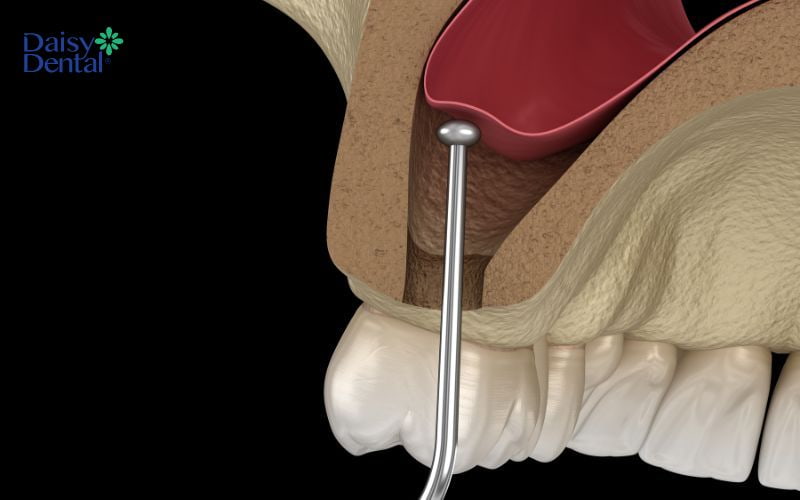 Nâng xoang kín được thực hiện qua một lỗ nhỏ trên mô nướu chân răng