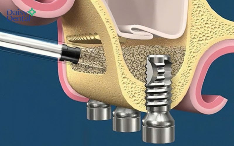 Kỹ thuật này được thực hiện thông qua vách ngăn của nướu răng bên cạnh