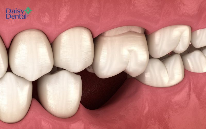 Kỹ thuật này thường được áp dụng với người bị mất răng và tiêu xương hàm