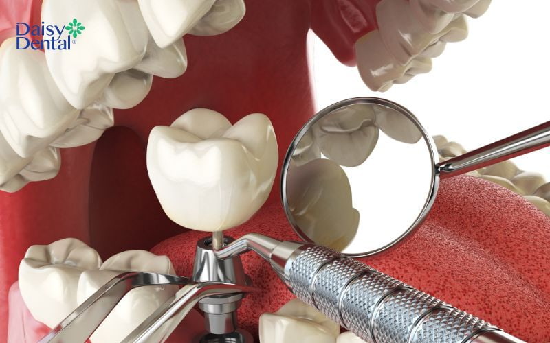 Kỹ thuật trồng Implant sẽ được thực hiện khi vết thương nâng xoang hở lành hẳn