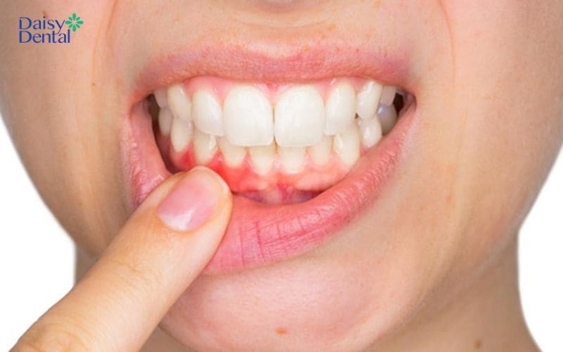 Túi lợi là một phần của niêm mạc miệng