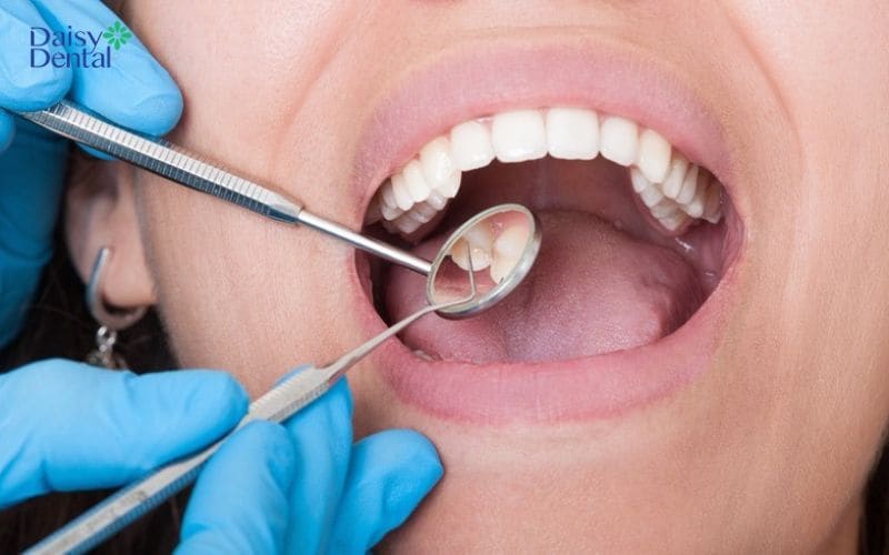 Phẫu thuật nạo túi lợi giúp điều trị các bệnh lý viêm quanh răng
