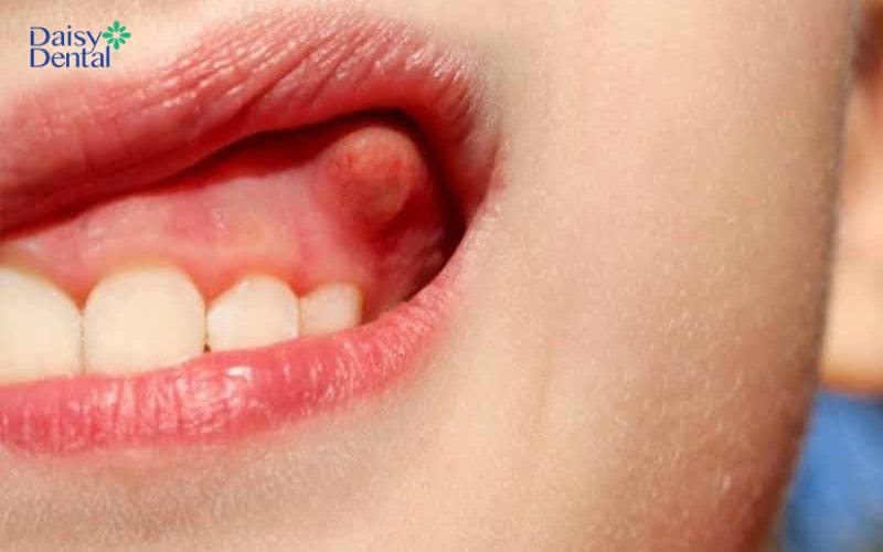 Túi lợi có cấu trúc xơ dày và cần điều trị giảm viêm