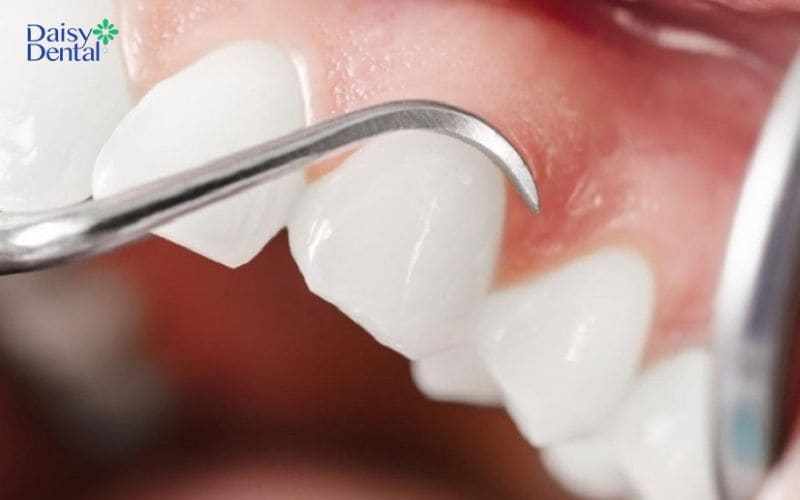 Nạo túi lợi khá nhẹ nhàng và không gây đau đớn
