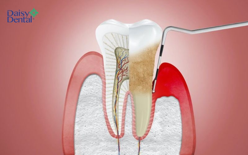 Túi nha chu là khoảng hở giữa nướu răng và chân răng