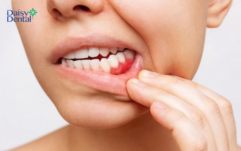 Nếu thấy nướu răng bị sưng viêm, bạn nên đến gặp bác sĩ ngay để được xử lý kịp thời
