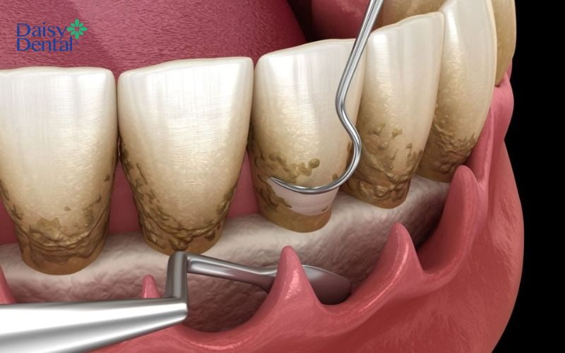 Sau khi làm sạch và gây tê, bác sĩ sẽ tiến hành nạo túi nha chu