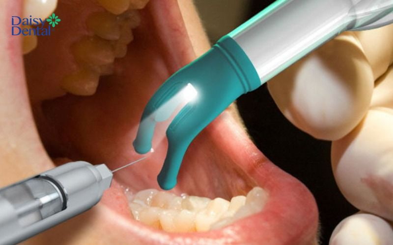 Bác sĩ sẽ gây tê để giảm đau nhức cho người bệnh