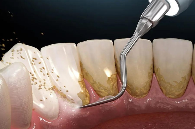 Cạo vôi răng là một trong những phương pháp điều trị tình trạng ngứa chân răng, viêm nhiễm lợi. 