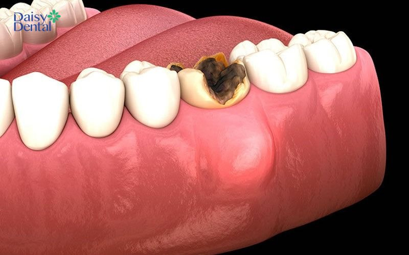 Tình trạng viêm áp xe ở chân răng