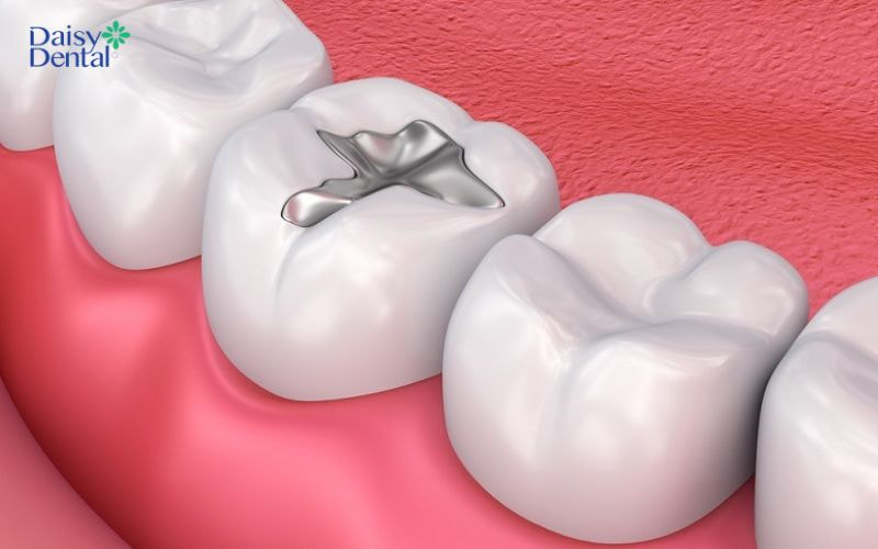 Trường hợp nhẹ chỉ cần trám hàn lại để bảo tồn răng
