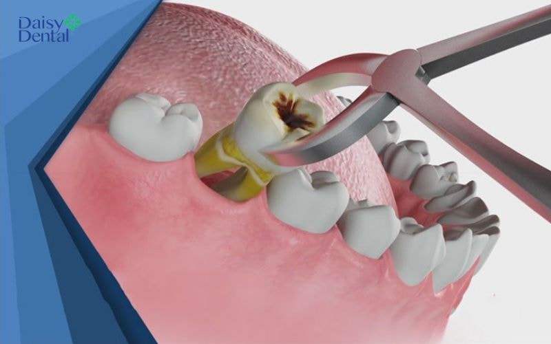 Nhổ răng đã lấy tủy vẫn có thể gây cảm giác đau
