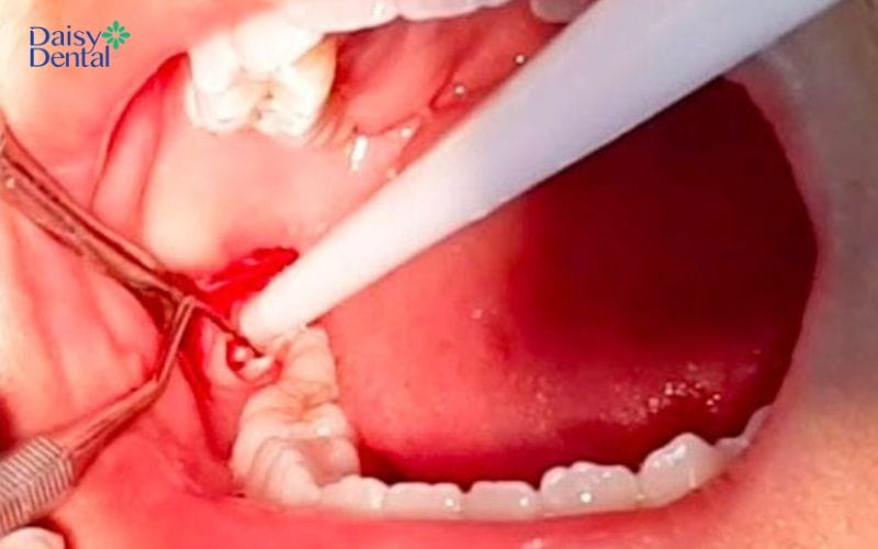 Chảy máu quá nhiều ở vết thương sau nhổ răng khôn