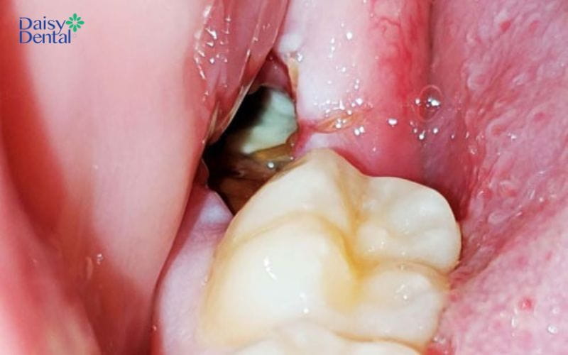 Viêm xương ổ răng sau khi thực hiện nhổ răng khôn