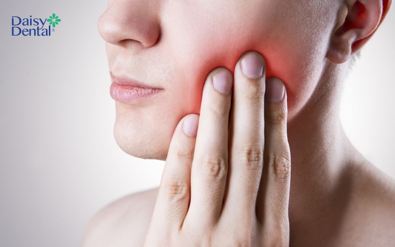 Sau khi nhổ răng khôn, bệnh nhân thường gặp tình trạng sưng má