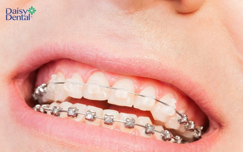 Niềng răng cải thiện khả năng ăn nhai