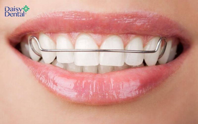 Sau khi tháo niềng răng, bạn cần đeo hàm duy trì theo hướng dẫn của bác sĩ để giúp răng ổn định