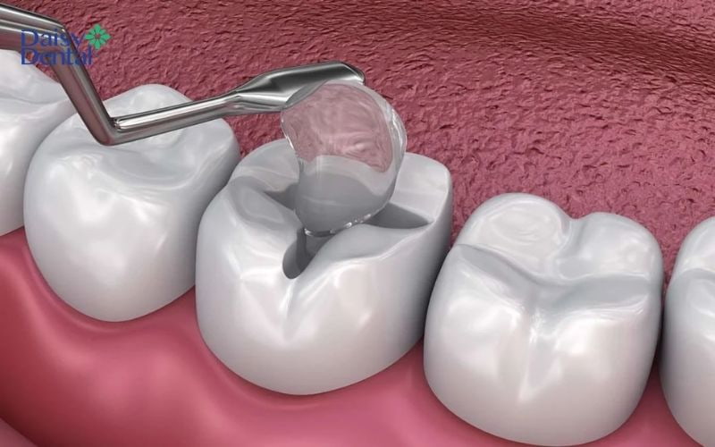 Miếng trám răng bị rớt ra do nhiều nguyên nhân khác nhau
