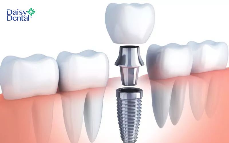 Phục hình răng sứ là công đoạn hoàn thiện quá trình trồng răng Implant