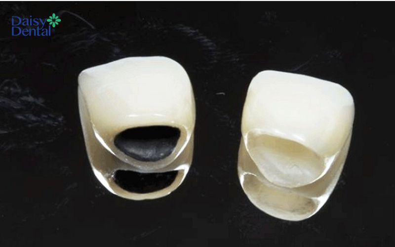 Răng sứ titan và răng toàn sứ