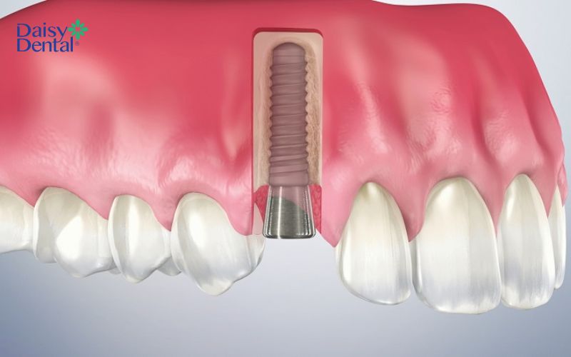 Trụ lành thương được gắn trước khi phục hình răng sứ cho bệnh nhân