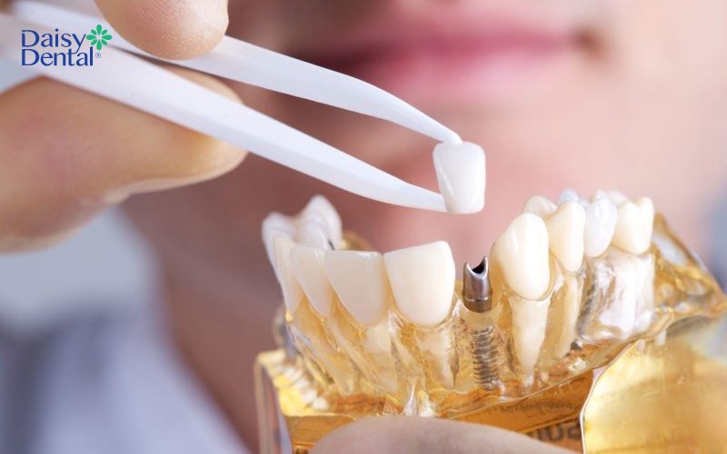 Tiến hành gắn răng sứ được chế tác theo thông tin của khách hàng