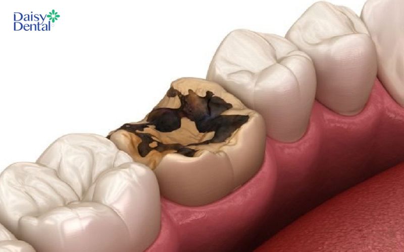 Răng 46 cần được bảo tồn và hạn chế nhổ