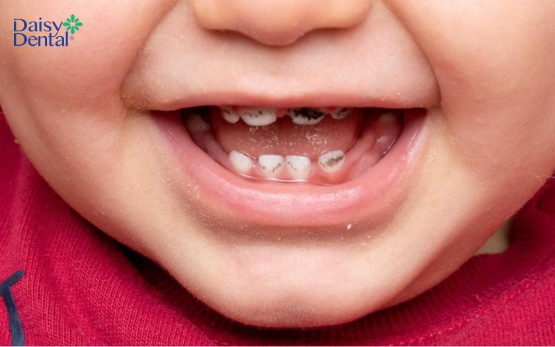 Men răng yếu cũng là lý do khiến răng sữa bé bị đen