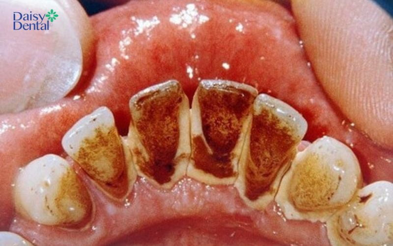 Vôi răng tích tụ lâu ngày là một trong những nguyên nhân gây ra đốm đen