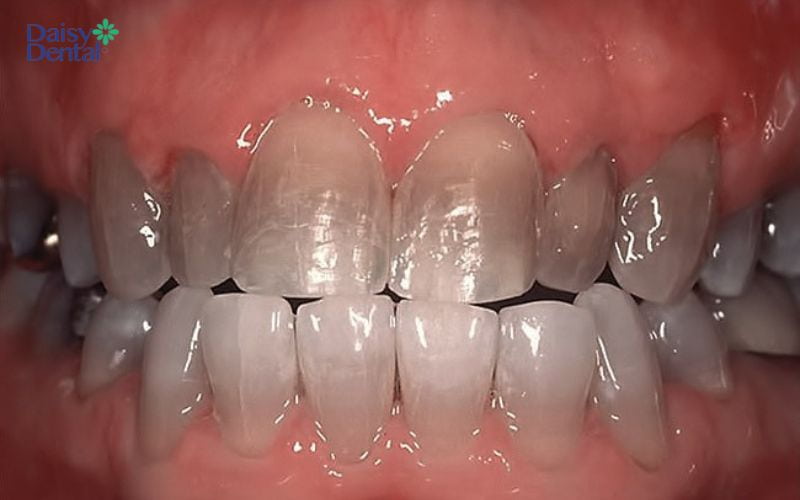 Răng nhiễm thuốc kháng sinh có thể chuyển sang màu đen