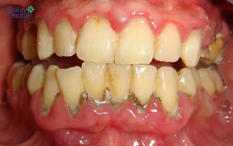 Răng có vết đen không điều trị có thể gây viêm nha chu