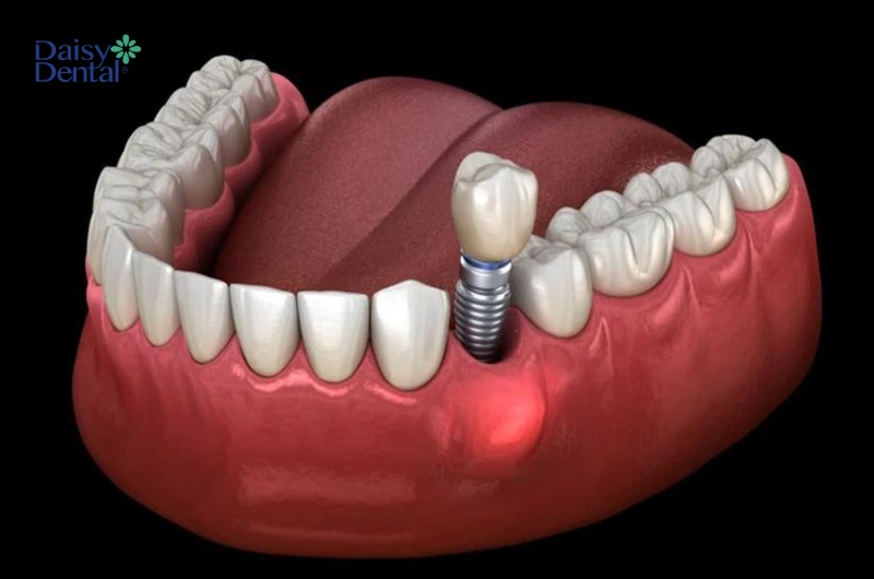 Người bệnh nên điều trị triệt để các bệnh lý răng miệng trước khi cấy ghép Implant.