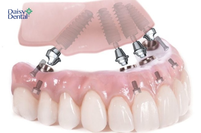Tùy vào số lượng trụ Implant mà người bệnh có thể thấy đau nhức ít hoặc nhiều.