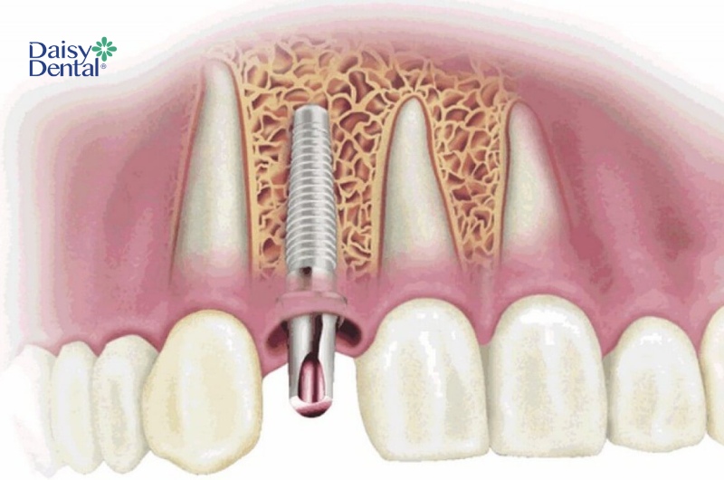 Trụ Implant tích hợp xương hàm là một trong những điều vô cùng quan trọng khi phục hình răng.