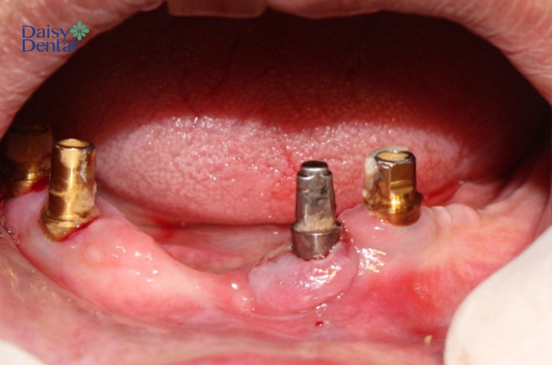Đào thải Implant là một trong những nguyên nhân gây ra đau nhức vị trí trồng răng.