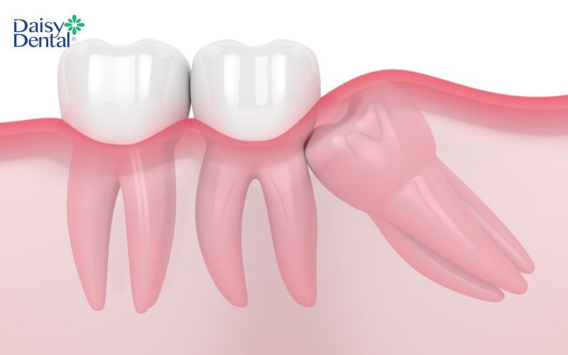 Răng khôn mọc ngầm là tình trạng răng bị mắc kẹt dưới nướu, không thể trồi lên được
