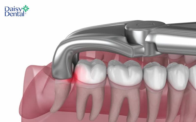 Răng khôn mọc ngầm có khả năng gây biến chứng, ảnh hưởng đến sức khỏe cần được nhổ bỏ