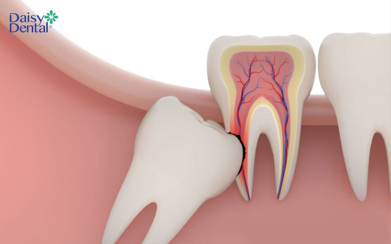 Răng khôn mọc ngầm gây ảnh hưởng đến răng số 7