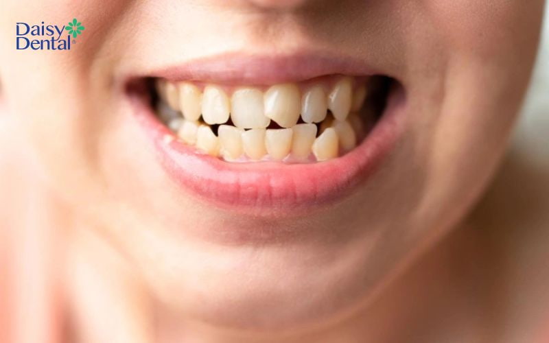 Răng lệch nhân trung khi kẽ hai răng cửa bị lệch so với đường nhân trung