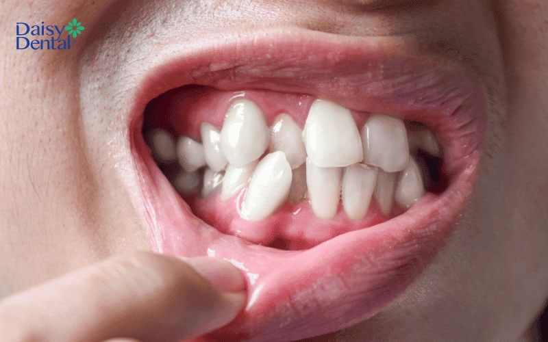 Lệch nhân trung có thể do di truyền